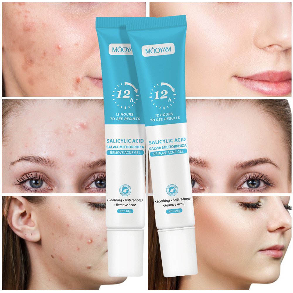 mooyam salicylic acid acne cream mooyam salicylic acid acne cream